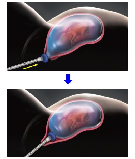 Lee's Cerclage Balloon